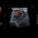 Histiocytoma, recurrence, malignant histiocytoma: US - Ultrasound